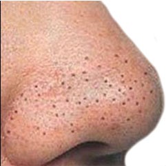 Угревая сыпь и КБХ угревая сыпь